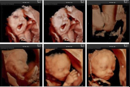 Ecografía 4D — Imagen 4