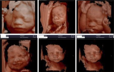 Ecografía 4D — Imagen 9